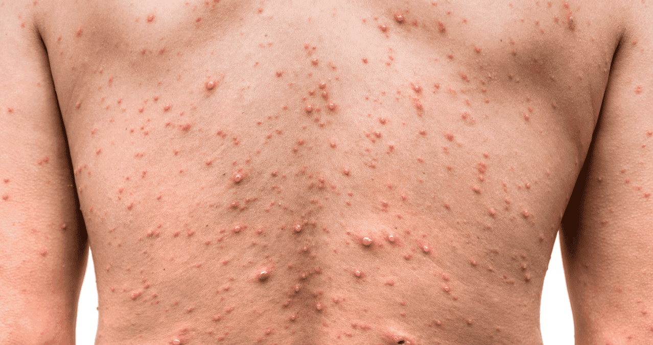 Viruela de Mono en Argentina: Pero ¿Qué es?