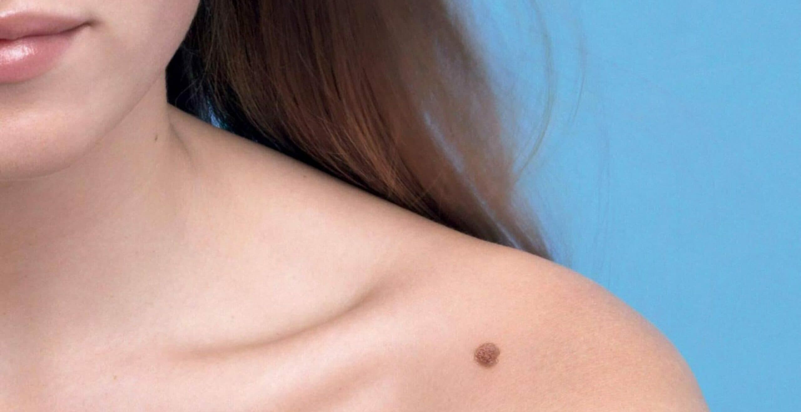 Cuidados y prevención del cáncer de piel