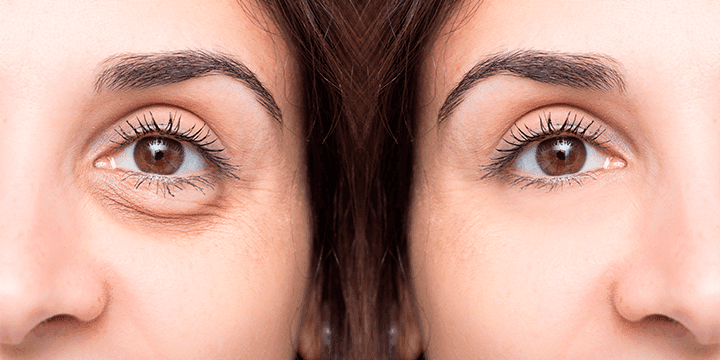 Todo lo que debes saber sobre las ojeras